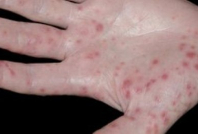 Hand, foot and mouth disease: First vaccine