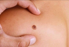 What is melanoma and what are the early signs of the skin cancer?