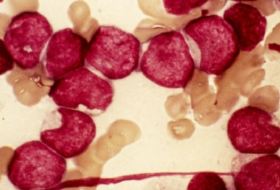 Study says a major blood cancer is 11 distinct diseases