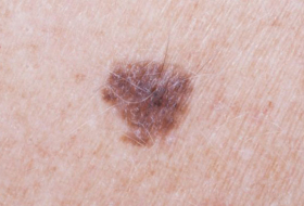 Arm mole count `predicts skin cancer risk`