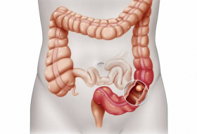 Healthy lifestyle improves survival outcomes in Colon Cancer