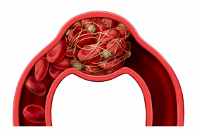  How to spot blood clot symptoms, and what to do about it? -  iWONDER  