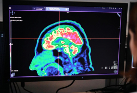 Scientists use AI to create drug regime for rare form of brain cancer in children