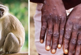   Australia records first case of human monkeypox  