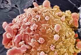 Skin cancer: Pair of drugs `eliminate 20% of tumours`
