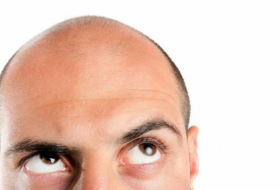 Research suggests being short and white may raise your risk of going bald