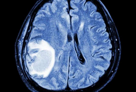 Brain tumours effectively treated by injecting patients with viruses