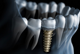 Chinese robot has performed the world's first automated dental implant