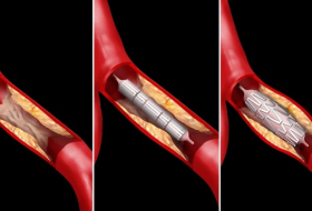 Do heart stents work? What you need to know