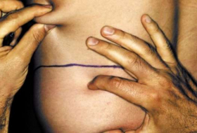 Doctors warn of rare but serious liposuction complication