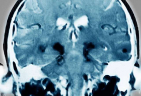 Just one head injury increases Parkinson's risk, study finds