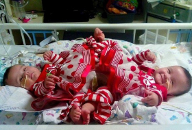 Conjoined Texas twins born as part of set of triplets get set for separation surgery 
